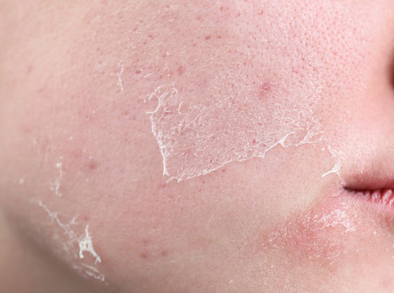 Thời tiết mùa đông độ ẩm và nhiệt độ thấp khiến hàng rào bảo vệ da suy yếu