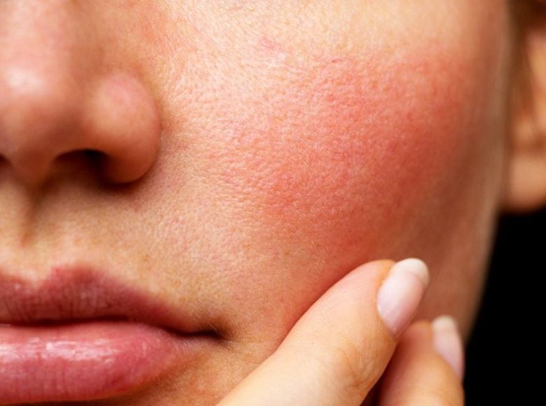 da bị kích ứng nên làm gì