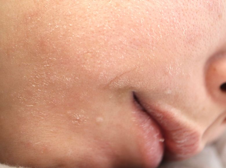 da sạm màu mùa đo·