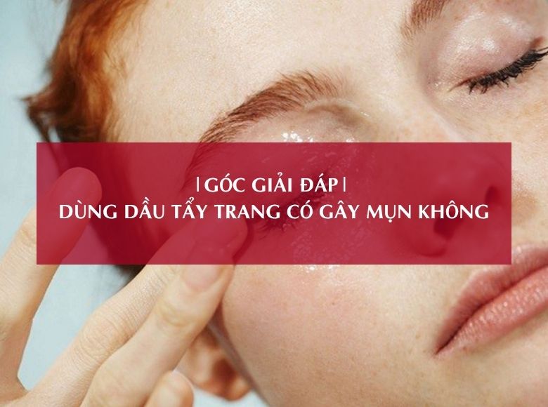 GÓC GIẢI ĐÁP – DÙNG DẦU TẨY TRANG CÓ GÂY MỤN KHÔNG?