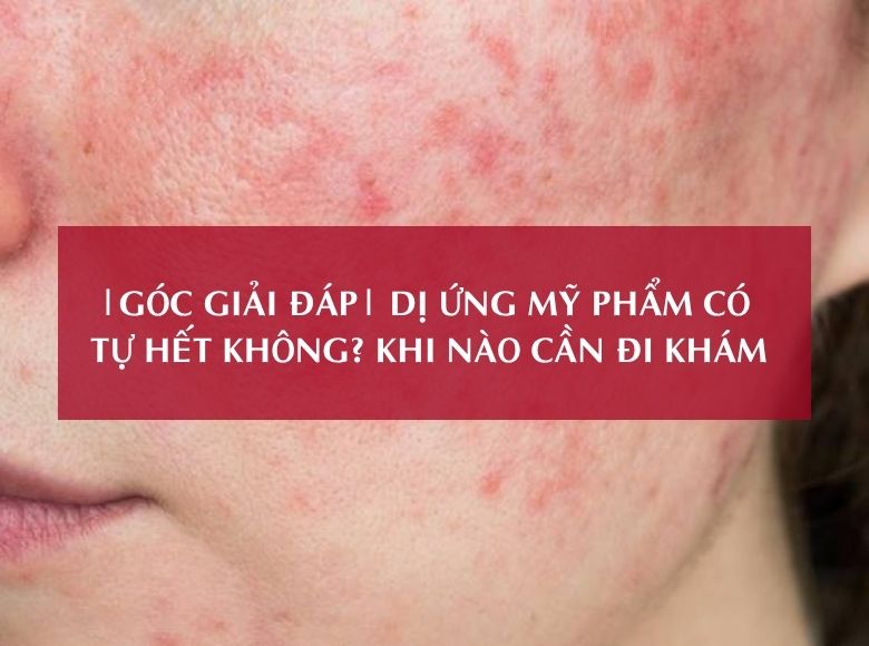 |GÓC GIẢI ĐÁP| DỊ ỨNG MỸ PHẨM CÓ TỰ HẾT KHÔNG? KHI NÀO CẦN ĐI KHÁM