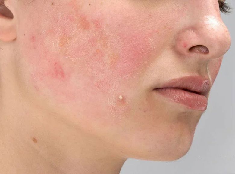 dị ứng mỹ phẩm có tự hết không