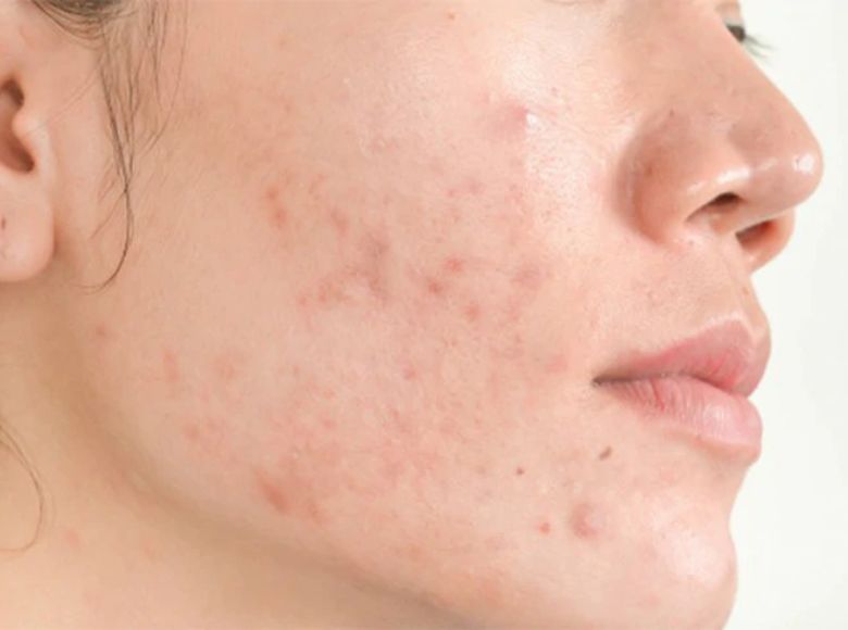 dị ứng mỹ phẩm có tự hết không