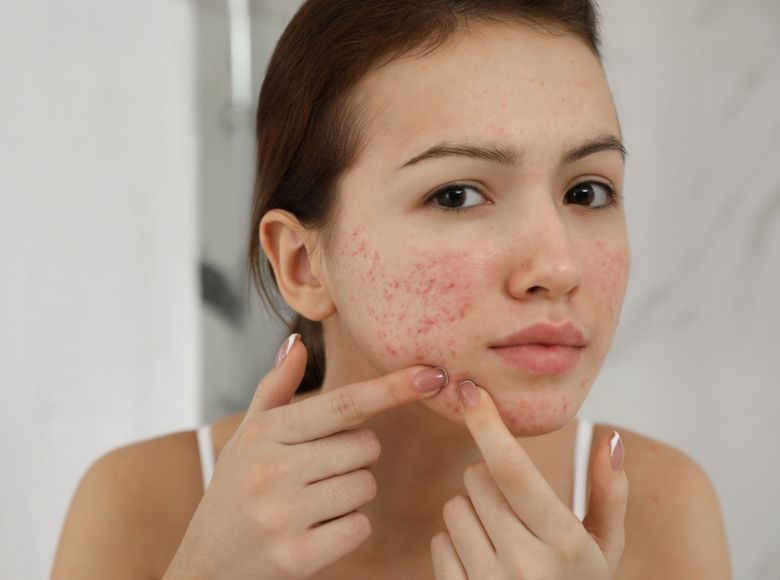 dị ứng mỹ phẩm có tự hết không