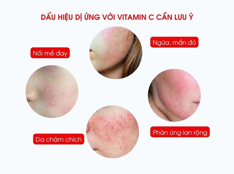 dị ứng với vitamin c