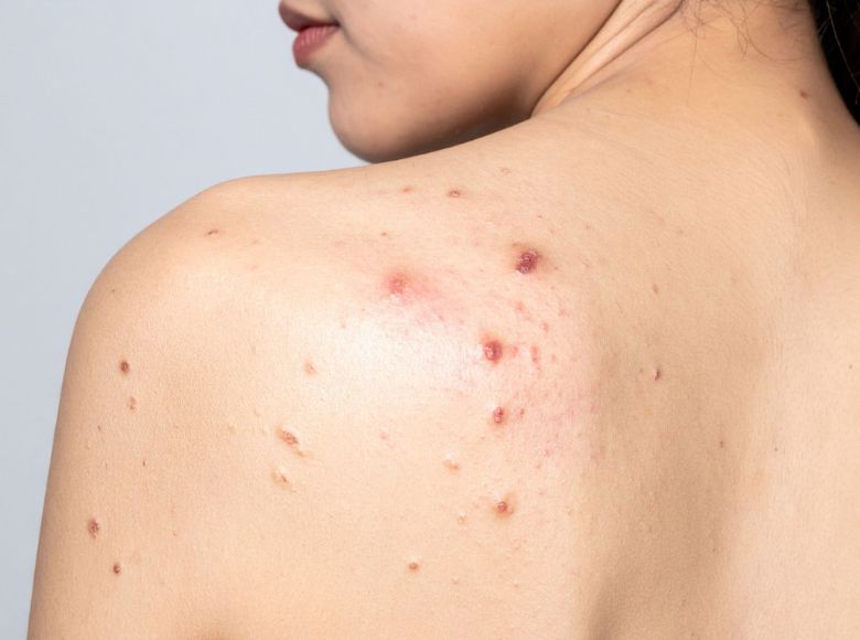 nguyên nhân gây mụn lưng ở nữ giới