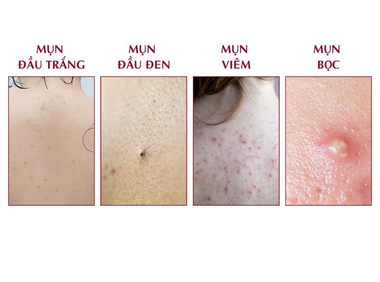 nguyên nhân gây mụn lưng ở nữ giới