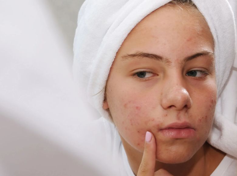 skincare cho tuổi dậy thì cần những gì